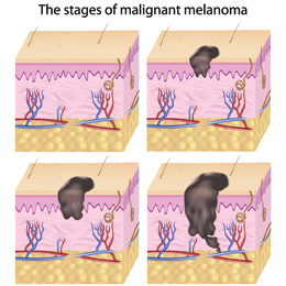 melanoma-structure